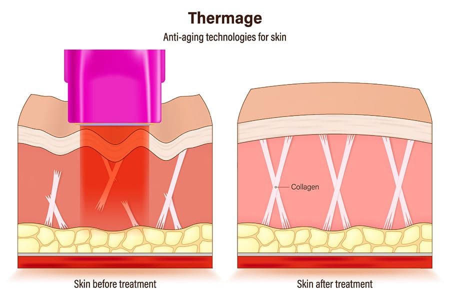 Thermage FLX treatment. Anti-aging technologies for skin. medical cosmetic procedures for skin. Compare skin condition before and after treatment - SOL Aesthetics